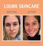 Clear Skin Unveiled: Your Guide to Acne-Free Complexion with LOUMI Skincare