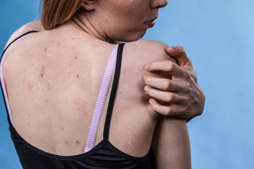 Keratosis Pilaris (KP): How to Smooth Your Skin and Regain Confidence