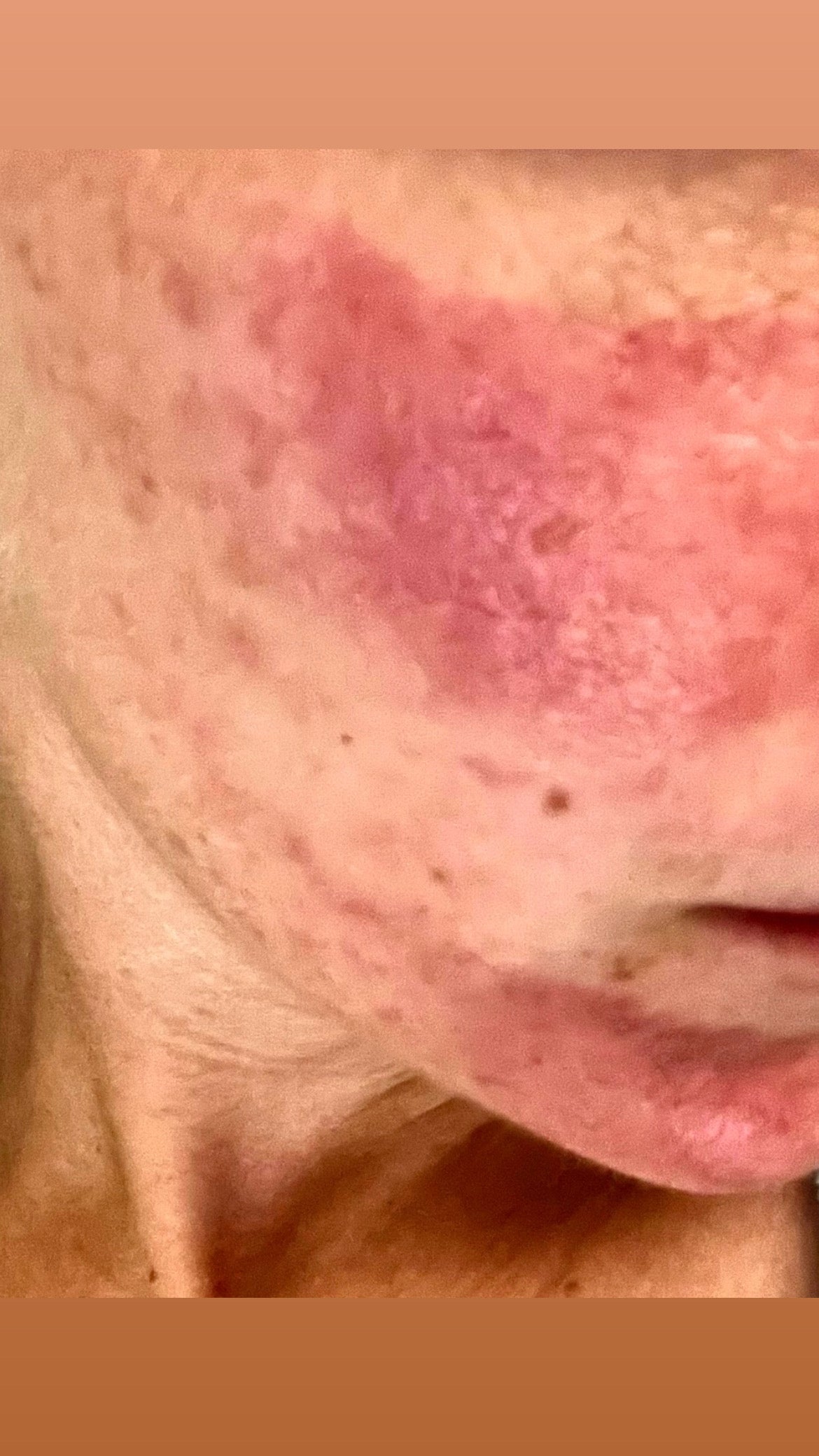 Understanding Hives: Types, Triggers, and Tips