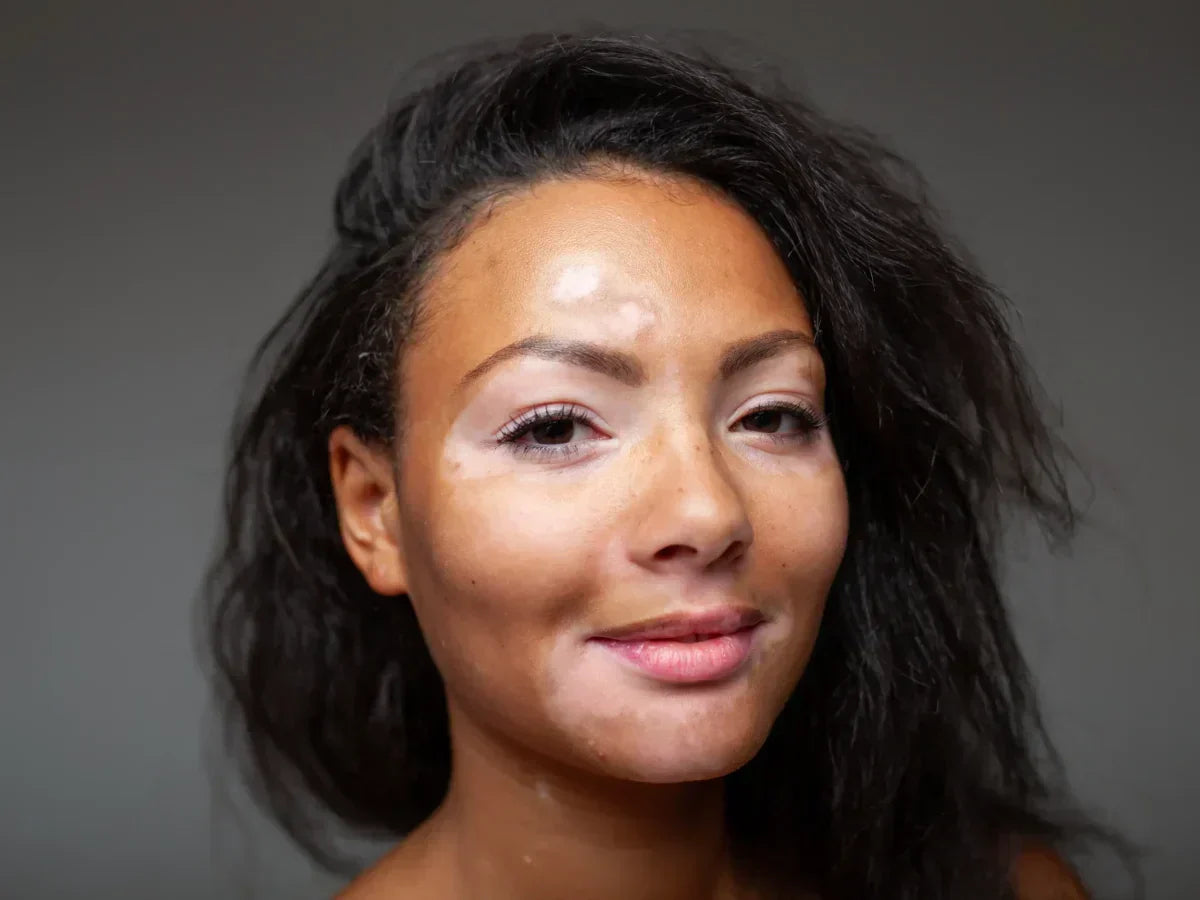 World's Rarest Skin Color Rare and Unique Skin Conditions Explained Guide